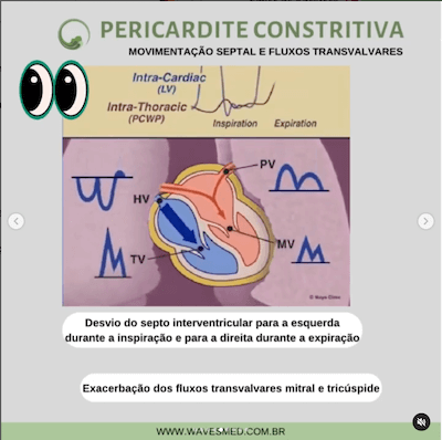 Movimentação septal pericardite constritiva Wavesmed