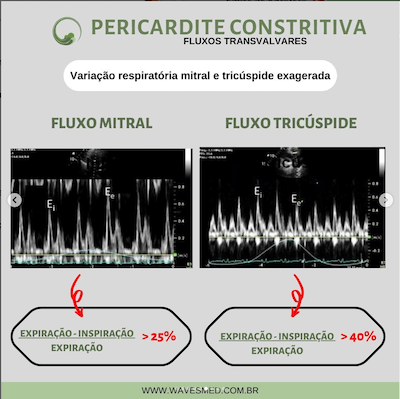 Fluxos transvalvares pericardite constritiva Wavesmed