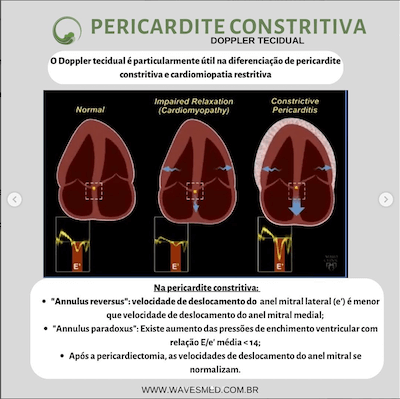 Doppler tecidual pericardite constritiva Wavesmed