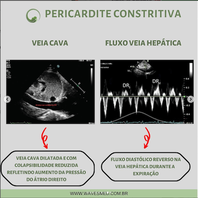 Avaliação veias pericardite constritiva Wavesmed