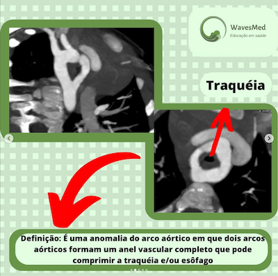 Definição duplo arco aórtico Wavesmed
