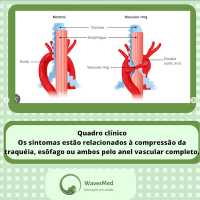 Quadro clinico duplo arco aórtico Wavesmed