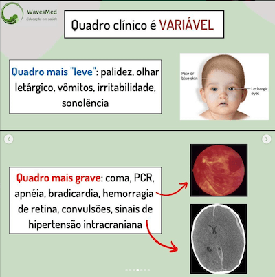 Quadro clinico shaken baby síndrome Wavesmed