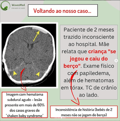 Caso clinico shaken baby síndrome Wavesmed