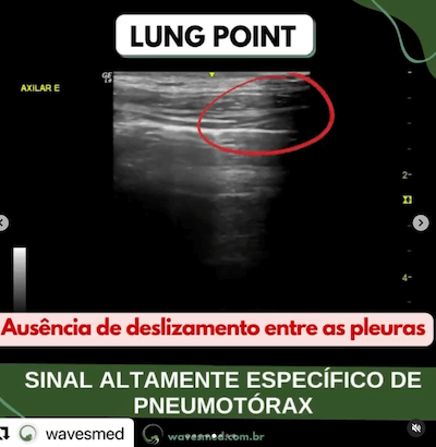 Lung point desafio USG tórax UTI Wavesmed