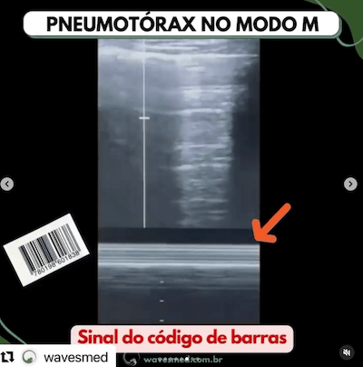 Pneumotórax modo m desafio USG tórax UTI Wavesmed