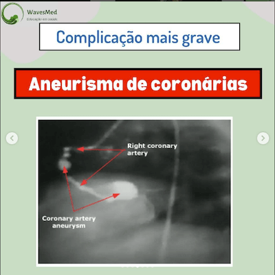 Complicações síndrome Kawasaki Wavesmed