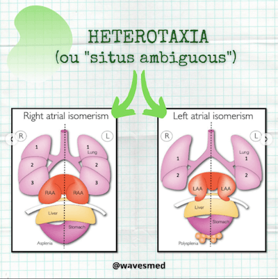 Isomerismo heterotaxias Wavesmed