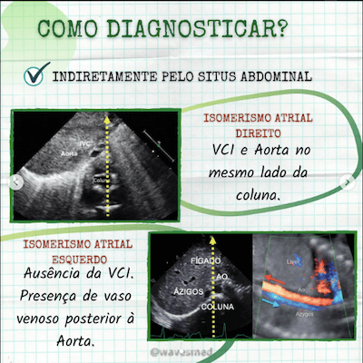 Diagnostico ECO heterotaxias Wavesmed