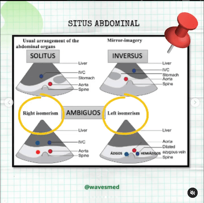 Situs abdominal heterotaxias Wavesmed