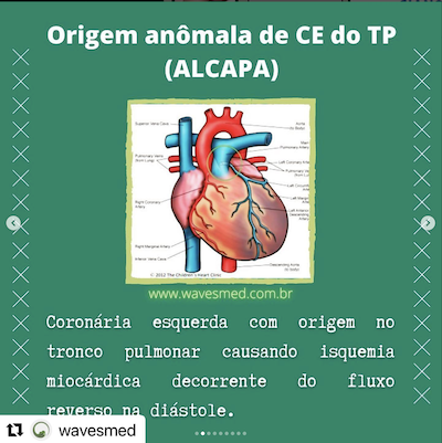 Definição  origem anômala coronária esquerda alcapa Wavesmed