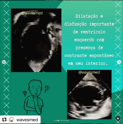 ECO origem anômala coronária esquerda alcapa Wavesmed