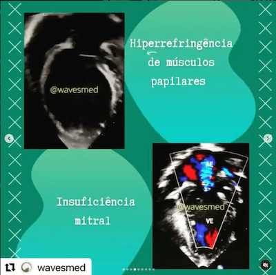 IM origem anômala coronária esquerda alcapa Wavesmed