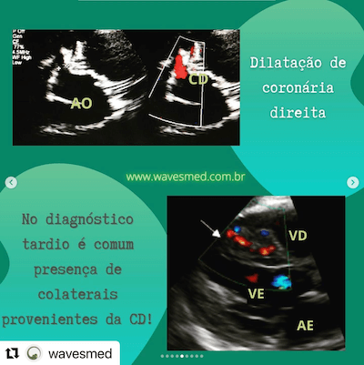 Dilatação coronária direita origem anômala coronária esquerda alcapa Wavesmed