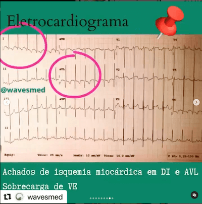 ECG origem anômala coronária esquerda alcapa Wavesmed