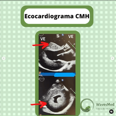 Ecocardiograma cardiomiopatia hipertrófica Wavesmed