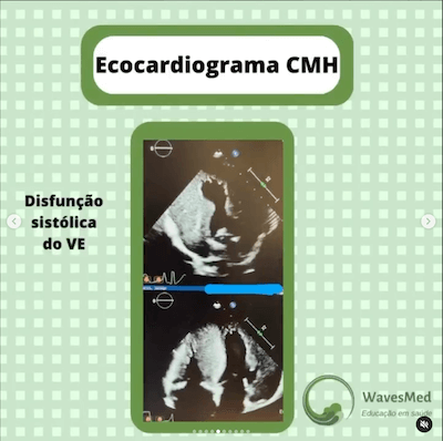 Ecocardiograma mioc cardiomiopatia hipertrófica Wavesmed