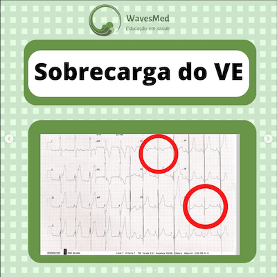 ECG sobrecarga VE cardiomiopatia hipertrófica Wavesmed