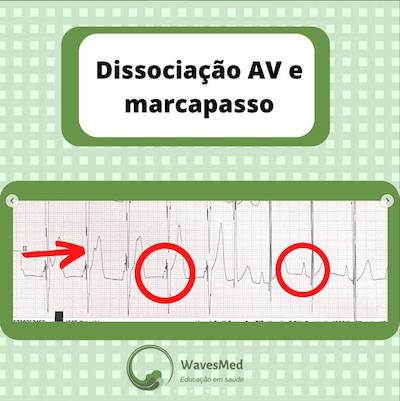 ECG marcapasso cardiomiopatia hipertrófica Wavesmed