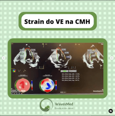 Strain cardiomiopatia hipertrófica Wavesmed