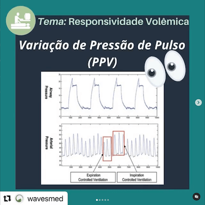 Variação de pressão de pulso responsividade volêmica Wavesmed