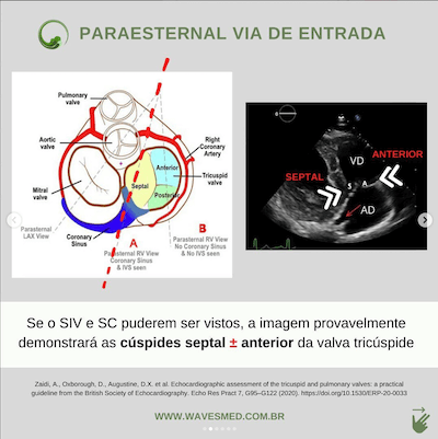 Paraesternal via de entrada valva tricúspide ecocardiograma Wavesmed