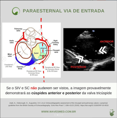 Paraesternal valva tricúspide ecocardiograma Wavesmed