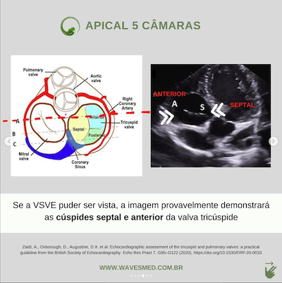 Apical 5 câmaras valva tricúspide ecocardiograma Wavesmed