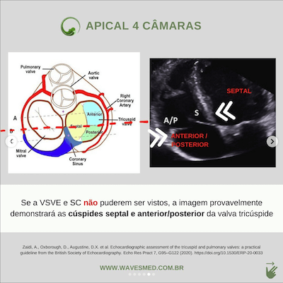 Apical 4 câmaras valva tricúspide ecocardiograma Wavesmed