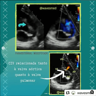 Ecocardiograma CIV duplamente relacionada Wavesmed