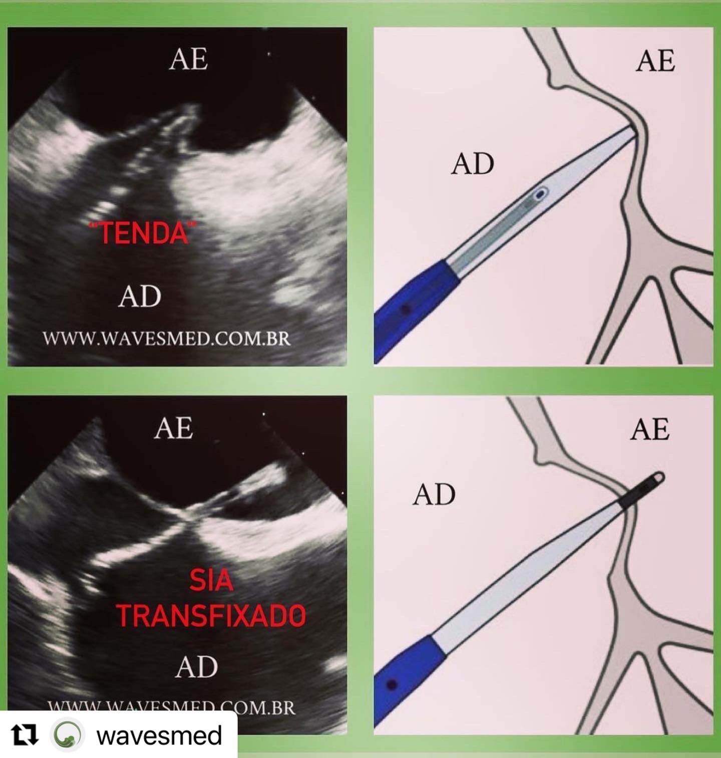 Punção septal atrial Wavesmed