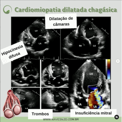 Ecocardiograma miocardiopatia chagásica Wavesmed