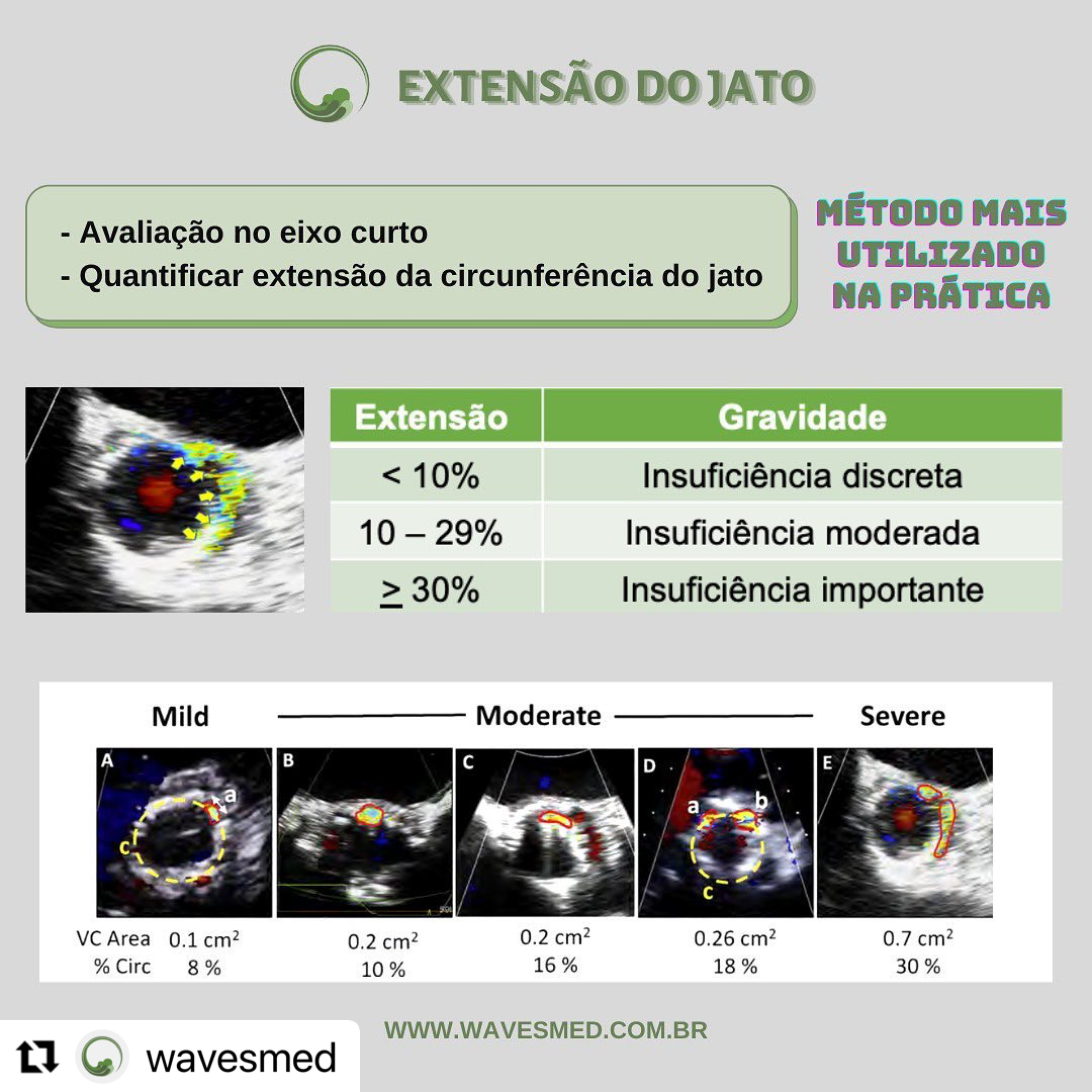 Leak paraprotetico na TAVI Wavesmed