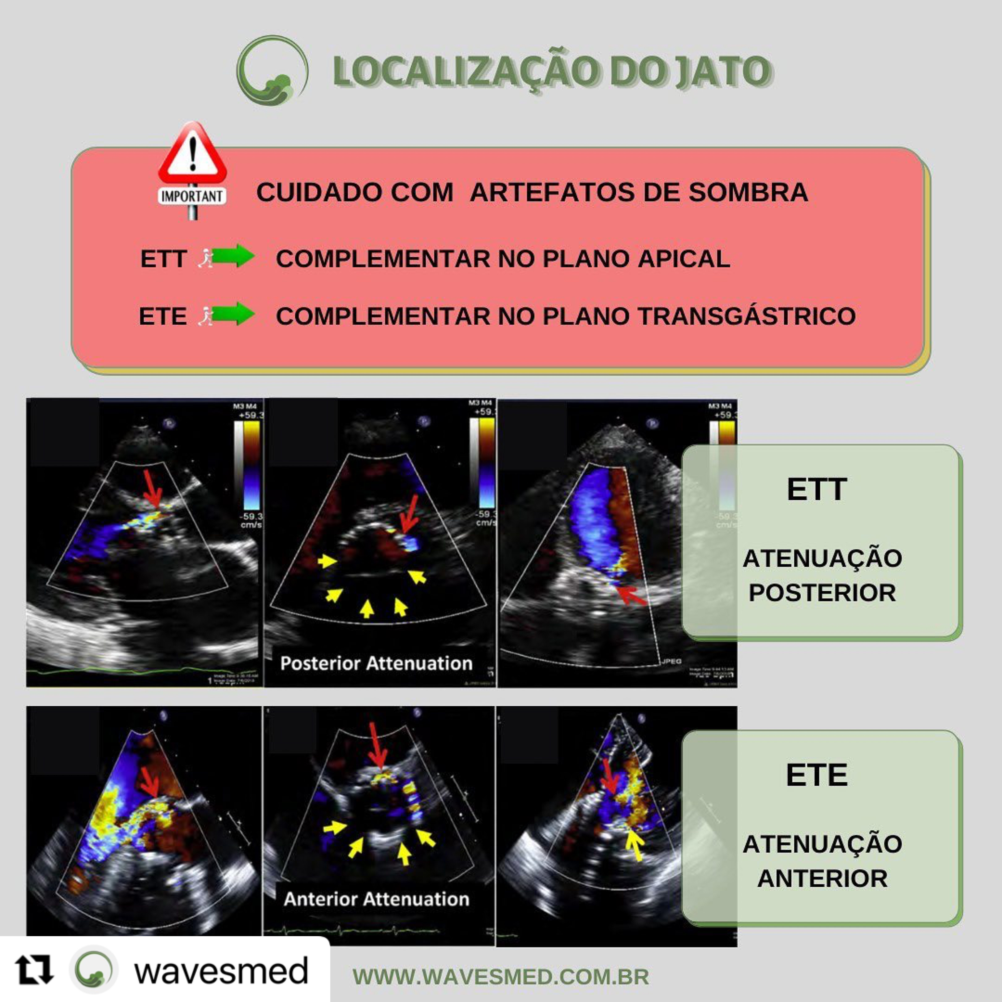 Leak paraprotetico na TAVI Wavesmed