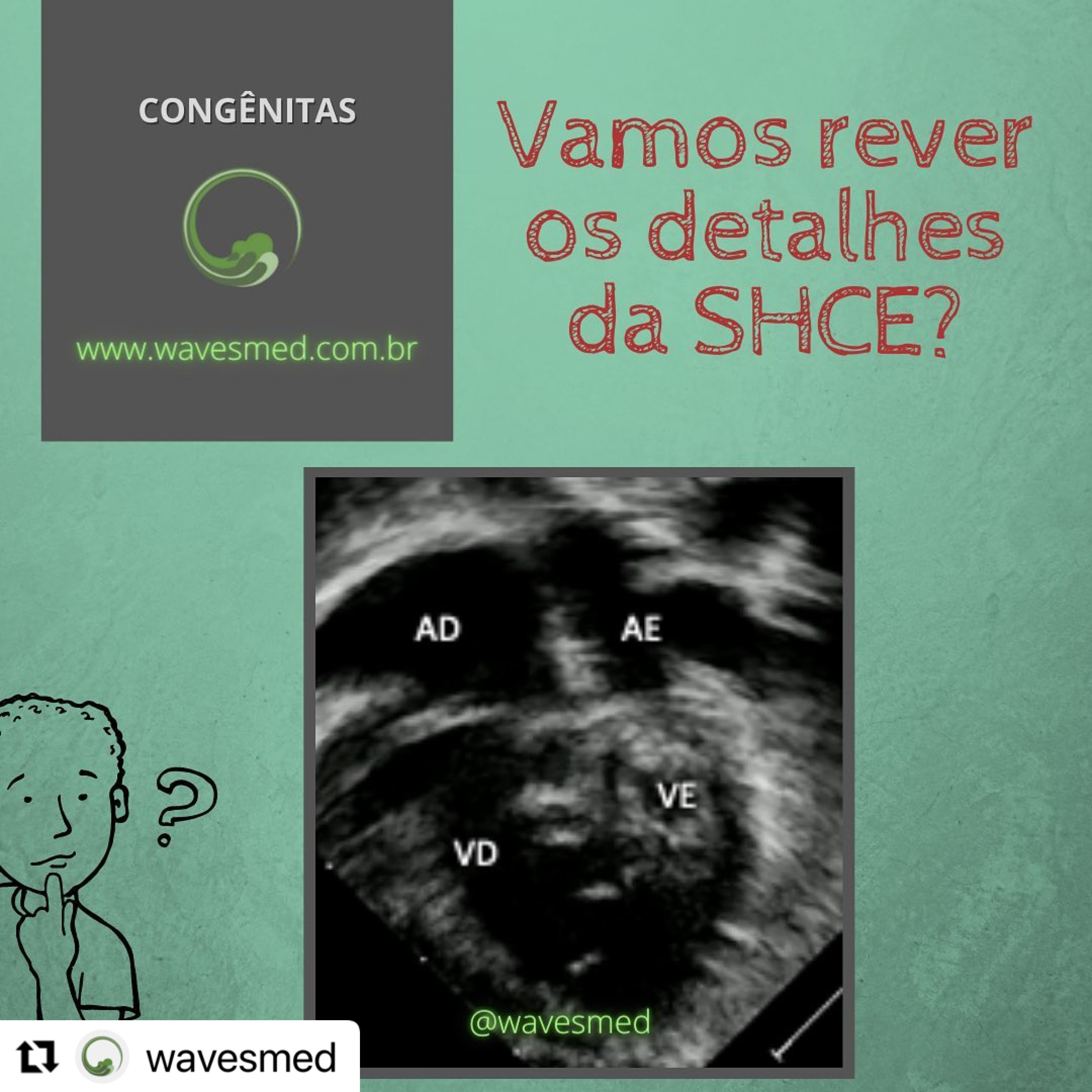 sindrome da hipoplasia do coracao esquerdo wavesmed