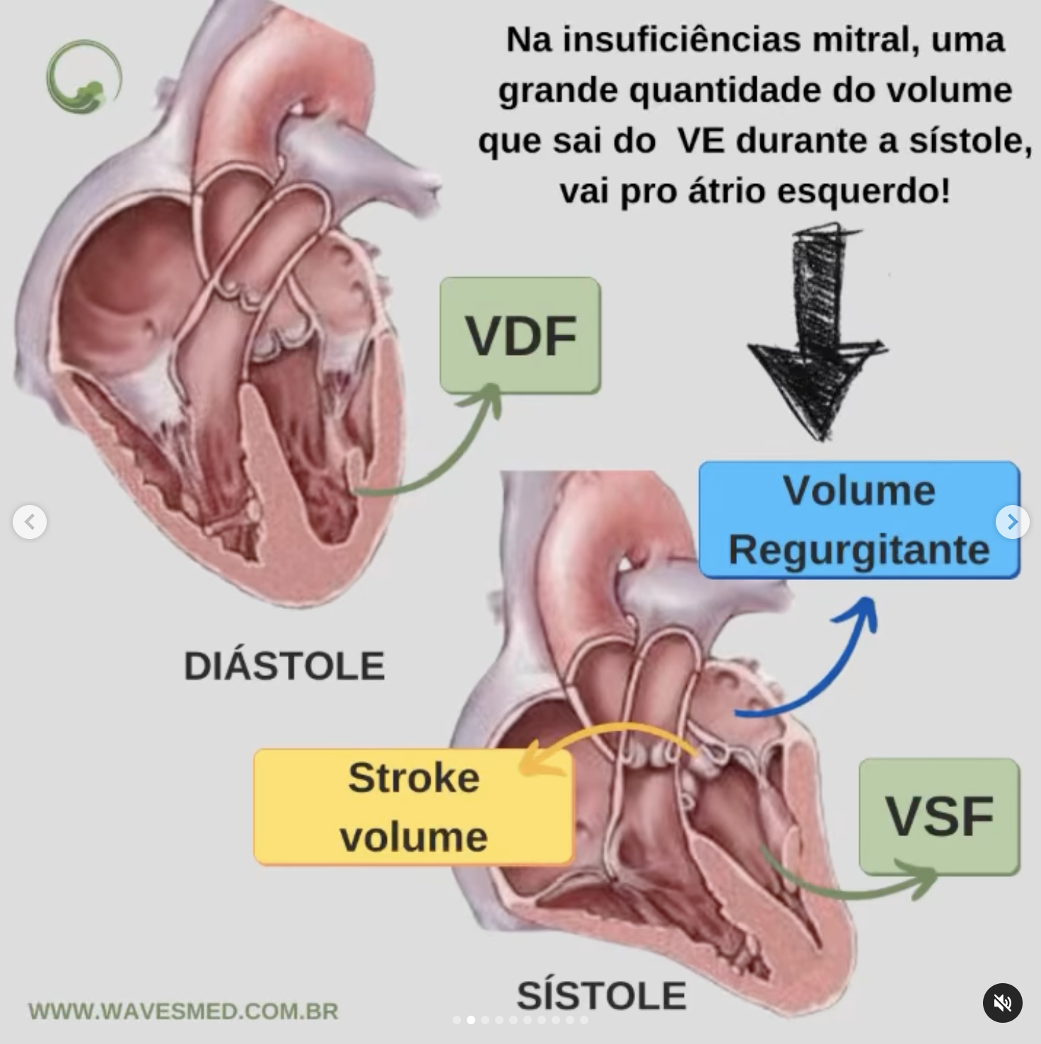 fisiopatologia da insuficiência mitral Wavesmed