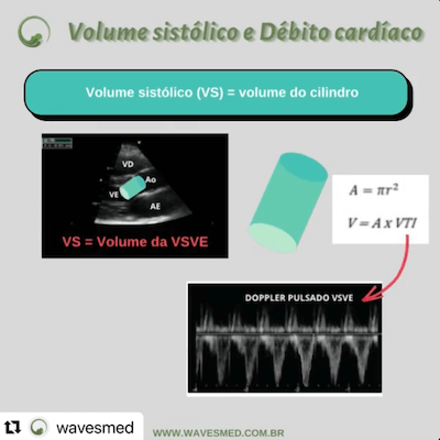 volume sistólico e débito cardiaco Wavesmed