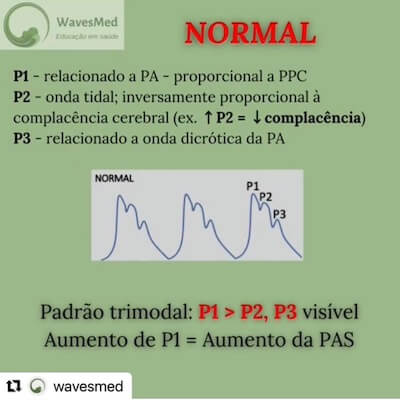 Curva de PIC normal Wavesmed<br />