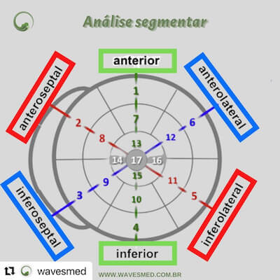 Função ventricular esquerda Wavesmed. Bulls eye