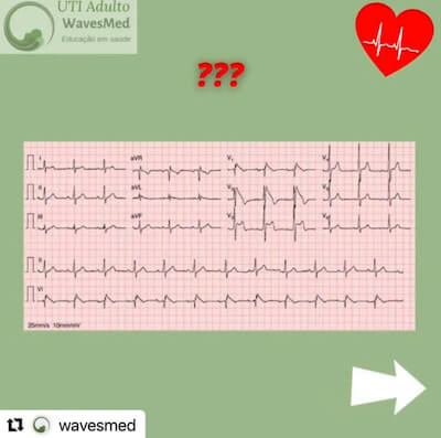 ECG Sd Brugada Wavesmed