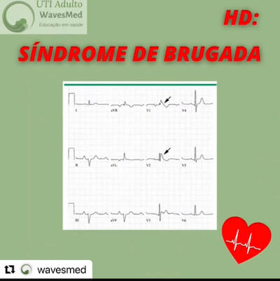 Sd Brugada Wavesmed