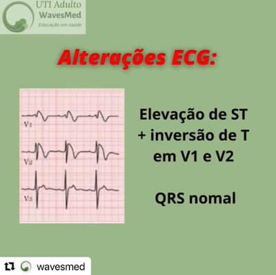 Elevação de SST Sd Brugada Wavesmed