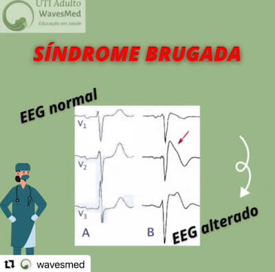 ECG Sd Brugada Wavesmed