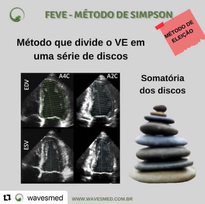 Fração de Ejeção VE Wavesmed<br />  Método Simpson<br />  Curso preparatorio para prova de título de ecocardiograma Wavesmed