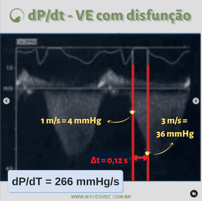 Função do ventrículo esquerdo no paciente com insuficiência mitral Wavesmed  dP/dt com disfunção