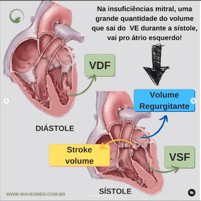 Função do ventrículo esquerdo no paciente com insuficiência mitral Wavesmed  Fisiopatologia de insuficiência mitral