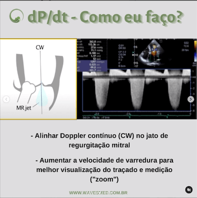 Função do ventrículo esquerdo no paciente com insuficiência mitral Wavesmed  dP/dt como eu faço?