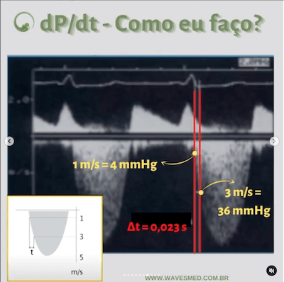 Função do ventrículo esquerdo no paciente com insuficiência mitral Wavesmed  Doppler dP/dt