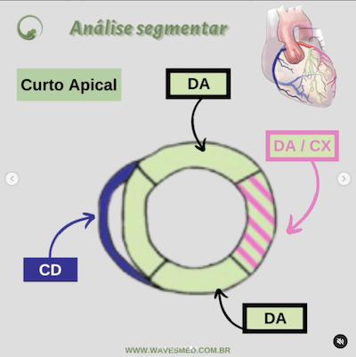 Função do ventrículo esquerdo. Como definir coronária? Wavesmed<br />  eixo curto