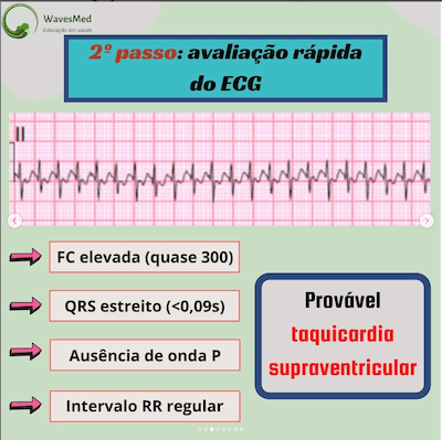 Taquicardia supraventricular Wavesmed<br />  Avaliação do ECG